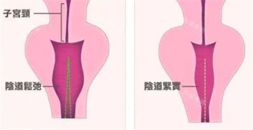 生物束帶緊縮術(shù)對比