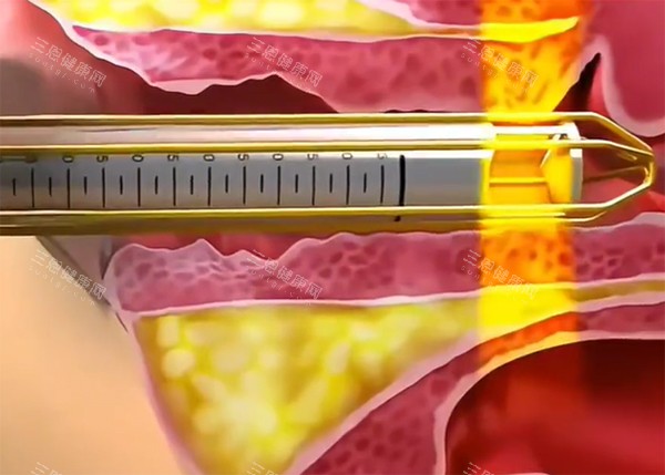 緊縮針推藥示意圖