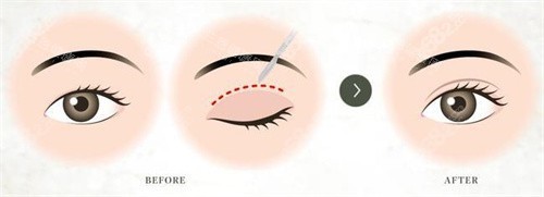 雙眼皮術(shù)對(duì)比宣傳圖