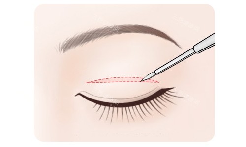 全切雙眼皮切口展示
