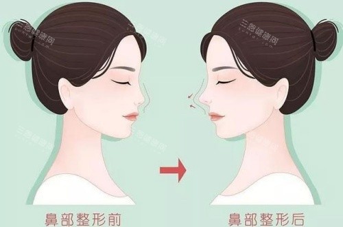 隆鼻術(shù)后漫畫示意圖