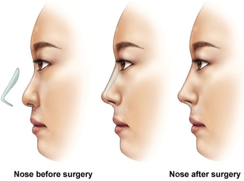 假體隆鼻手術(shù)前后對比