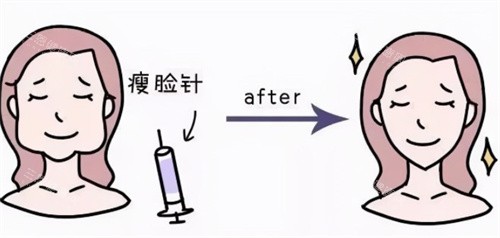 瘦臉注射前后卡通