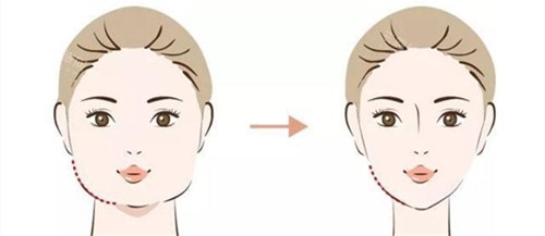 瘦臉手術(shù)前后對比動畫圖