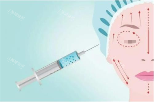 注射玻尿酸示意圖