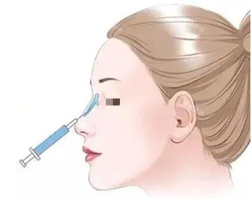 玻尿酸隆鼻示意圖