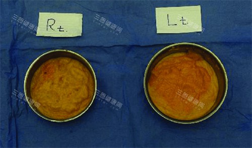 不明注射物取出來的樣子