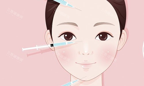 注射美容的部位示意圖