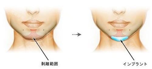 注射墊下巴示意圖