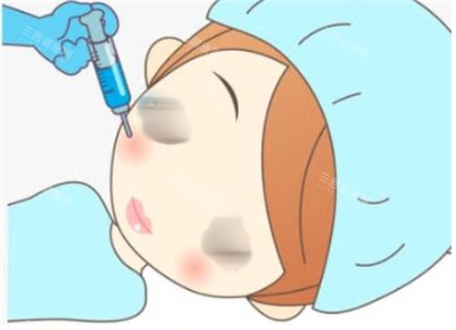 打針瘦臉手術(shù)過(guò)程圖