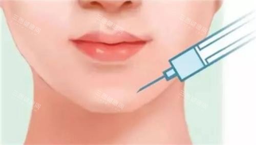 玻尿酸豐下巴的示意圖