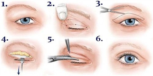 雙眼皮全切術(shù)過(guò)程圖